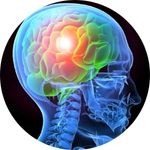 Traumatic Brain Injury (TBI)