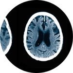 Mild Cognitive Impairment